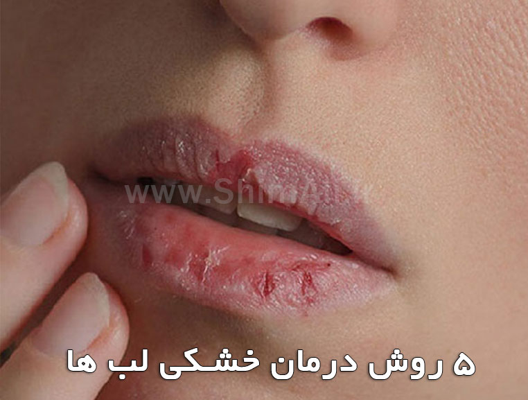 5 روش درمان خشکی لب ها